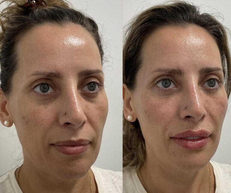 Before and after of a woman from a side profile option 4